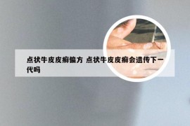 点状牛皮皮癣偏方 点状牛皮皮癣会遗传下一代吗