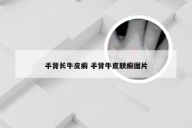 手背长牛皮癣 手背牛皮肤癣图片