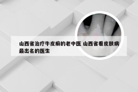 山西省治疗牛皮癣的老中医 山西省看皮肤病最出名的医生