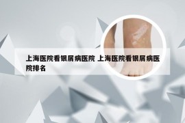 上海医院看银屑病医院 上海医院看银屑病医院排名