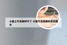 小腿上牛皮癣好不了 小腿牛皮肤癣的症状图片