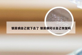银屑病自己就下去了 银屑病可以自己恢复吗