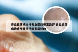 青岛银屑病治疗专业医院哪家最好 青岛银屑病治疗专业医院哪家最好的