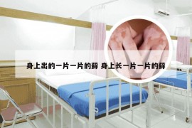 身上出的一片一片的藓 身上长一片一片的藓