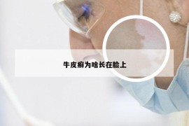 牛皮癣为啥长在脸上