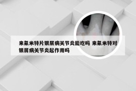 来氟米特片银屑病关节炎能吃吗 来氟米特对银屑病关节炎起作用吗