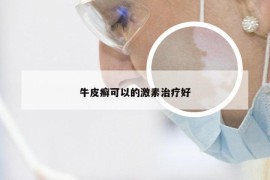 牛皮癣可以的激素治疗好