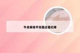 牛皮癣变平但是还是红痒