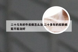 二十几年的牛皮癣怎么治 二十多年的皮肤病能不能治好