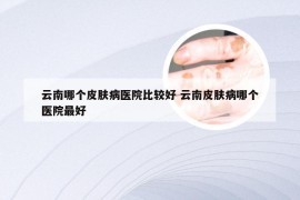 云南哪个皮肤病医院比较好 云南皮肤病哪个医院最好