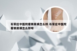石家庄中医院看银屑病怎么样 石家庄中医院看银屑病怎么样呀