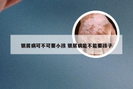 银屑病可不可要小孩 银屑病能不能要孩子