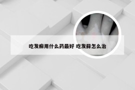 吃发癣用什么药最好 吃发藓怎么治