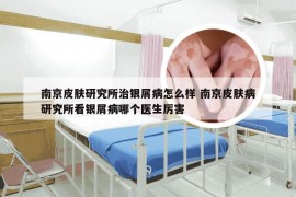 南京皮肤研究所治银屑病怎么样 南京皮肤病研究所看银屑病哪个医生厉害