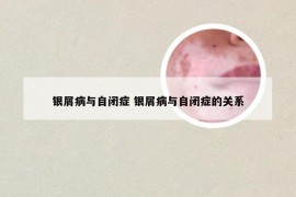 银屑病与自闭症 银屑病与自闭症的关系