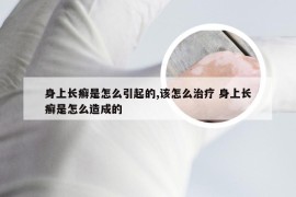 身上长癣是怎么引起的,该怎么治疗 身上长癣是怎么造成的