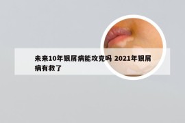 未来10年银屑病能攻克吗 2021年银屑病有救了