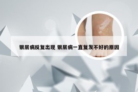 银屑病反复出现 银屑病一直复发不好的原因