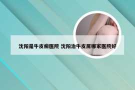 沈阳是牛皮癣医院 沈阳治牛皮屑哪家医院好