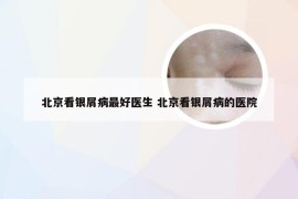 北京看银屑病最好医生 北京看银屑病的医院