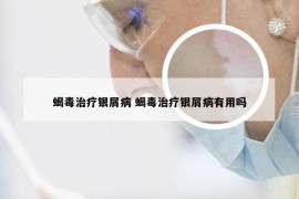 蝎毒治疗银屑病 蝎毒治疗银屑病有用吗