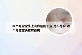 四个月宝宝头上有白色的干皮,是不是癣 四个月宝宝头皮有白斑