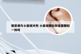 银屑病与小柴胡冲剂 小柴胡颗粒和柴银颗粒一样吗