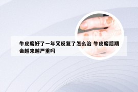 牛皮廨好了一年又反复了怎么治 牛皮廨后期会越来越严重吗