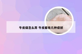 牛皮痫怎么弄 牛皮廨有几种症状