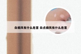 白癜风有什么危害 白点癫风有什么危害
