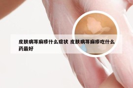 皮肤病荨麻疹什么症状 皮肤病荨麻疹吃什么药最好