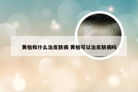 黄柏和什么治皮肤病 黄柏可以治皮肤病吗