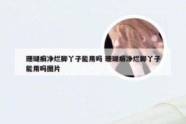 珊瑚癣净烂脚丫子能用吗 珊瑚癣净烂脚丫子能用吗图片