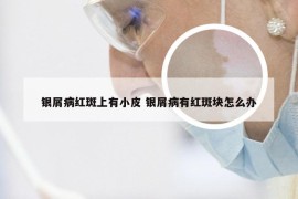 银屑病红斑上有小皮 银屑病有红斑块怎么办