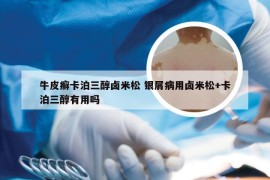 牛皮癣卡泊三醇卤米松 银屑病用卤米松+卡泊三醇有用吗