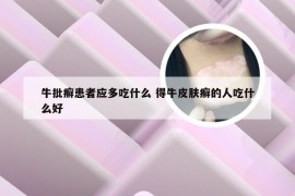 牛批癣患者应多吃什么 得牛皮肤癣的人吃什么好