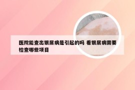 医院能查出银屑病是引起的吗 看银屑病需要检查哪些项目