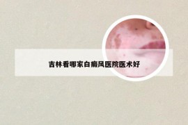 吉林看哪家白癜风医院医术好