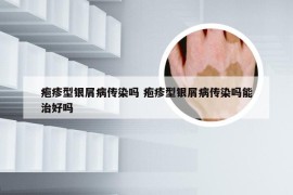 疱疹型银屑病传染吗 疱疹型银屑病传染吗能治好吗