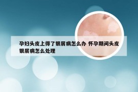 孕妇头皮上得了银屑病怎么办 怀孕期间头皮银屑病怎么处理