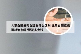 儿童白颠疯和白斑有什么区别 儿童白颠疯病可以治愈吗?要花多少钱