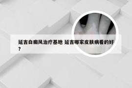 延吉白癜风治疗基地 延吉哪家皮肤病看的好?