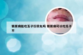 银屑病能吃五子衍宗丸吗 银屑病可以吃瓜子不