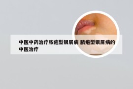 中医中药治疗脓疱型银屑病 脓疱型银屑病的中医治疗