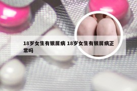 18岁女生有银屑病 18岁女生有银屑病正常吗
