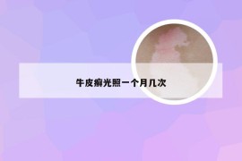 牛皮癣光照一个月几次