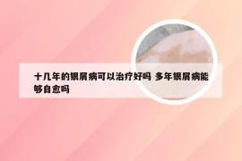 十几年的银屑病可以治疗好吗 多年银屑病能够自愈吗