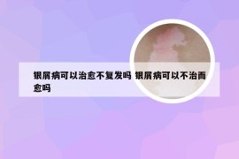 银屑病可以治愈不复发吗 银屑病可以不治而愈吗