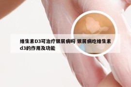 维生素D3可治疗银屑病吗 银屑病吃维生素d3的作用及功能