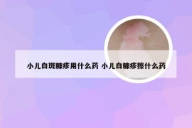小儿白斑糠疹用什么药 小儿白糠疹擦什么药